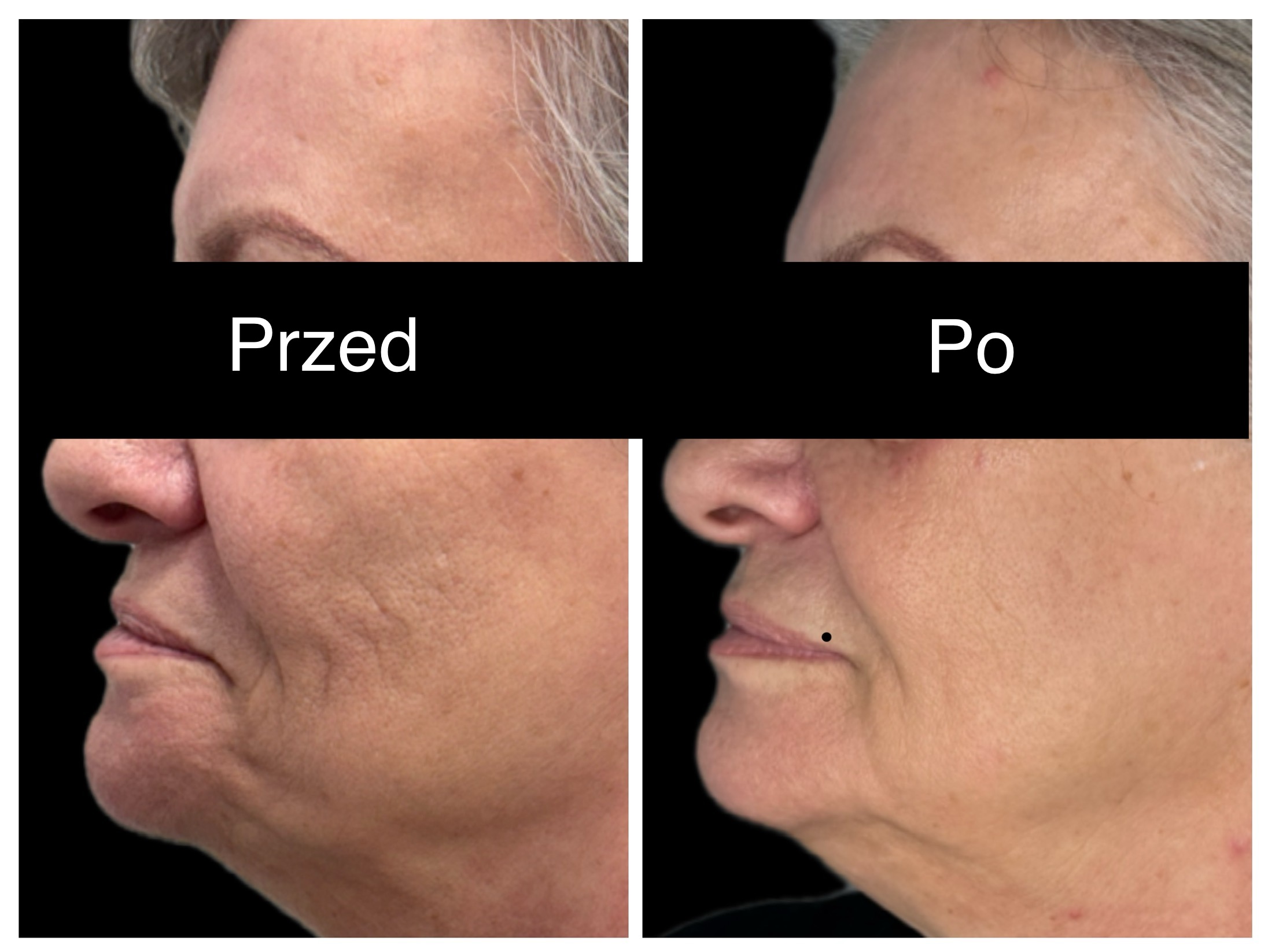 Efekt przed i po — Liftia Clinic
