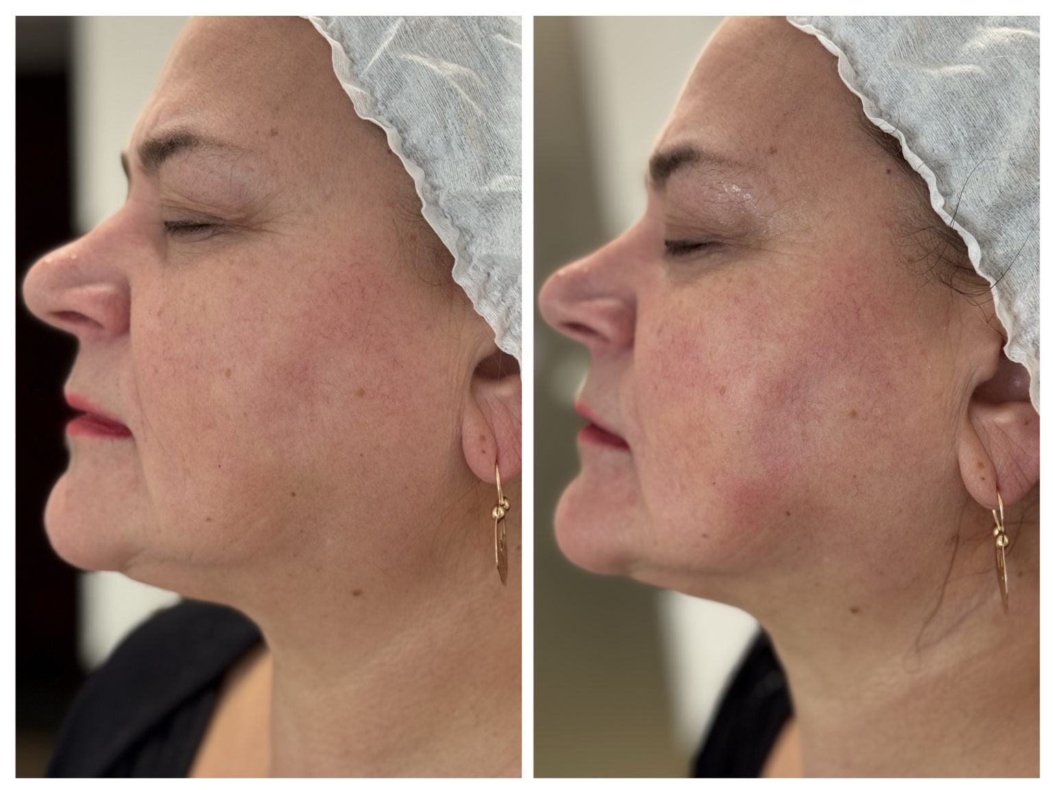 Efekt przed i po — Liftia Clinic