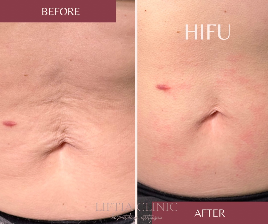 HIFU — efekt przed i po
